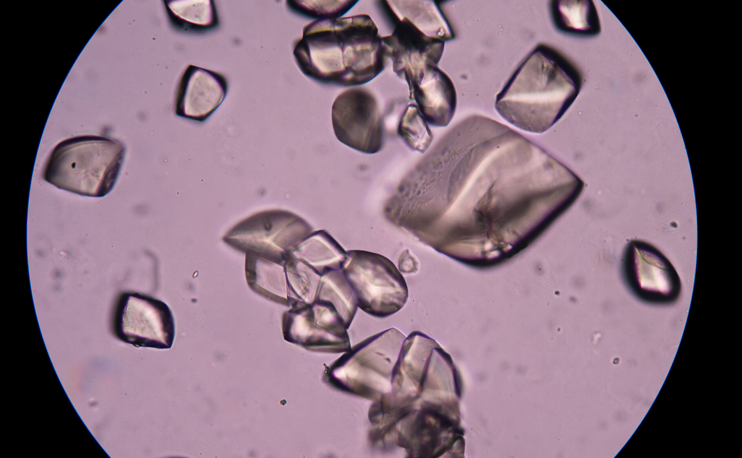 Uric acid in urine sediment