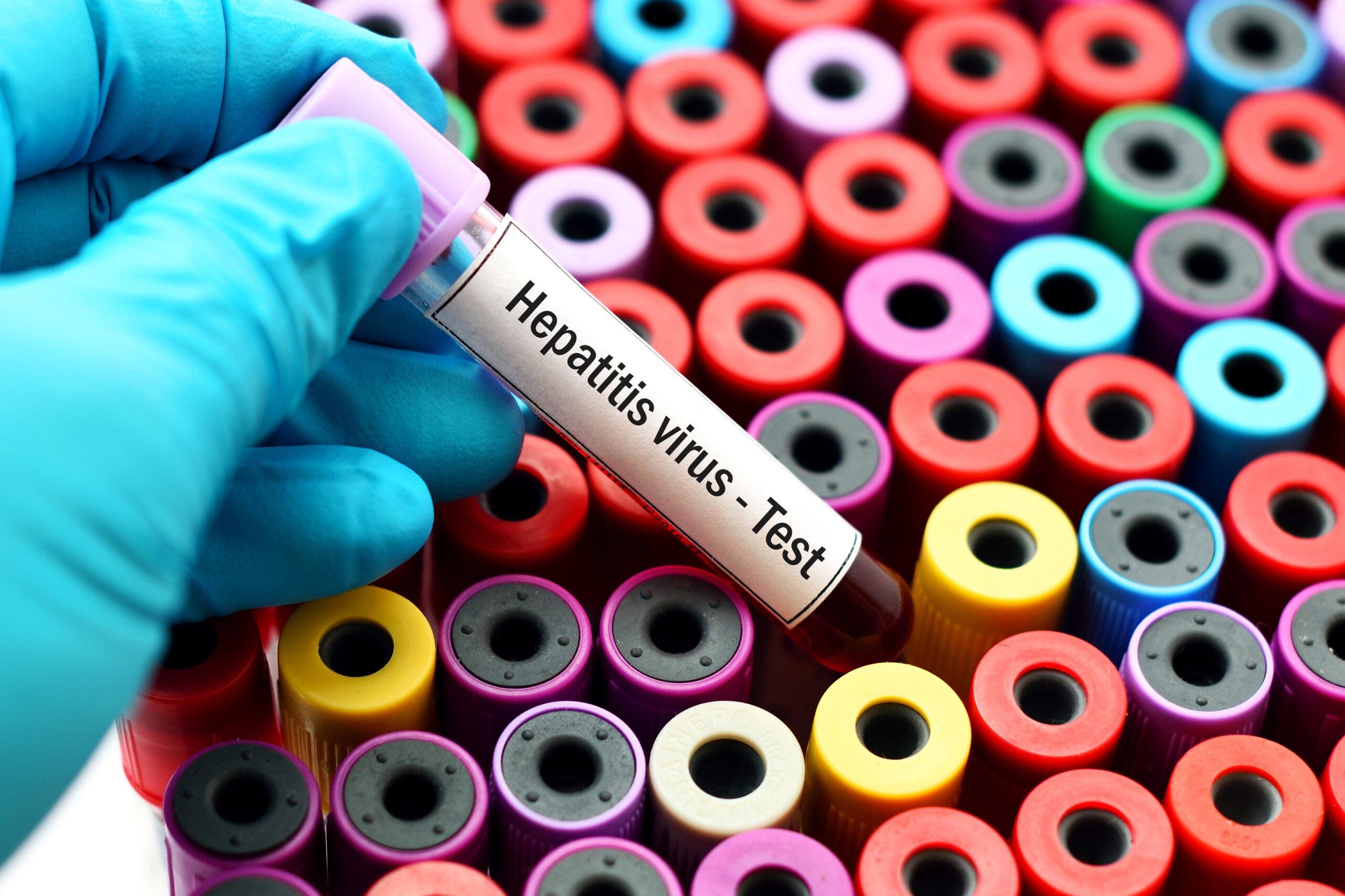 Hepatitis virus test