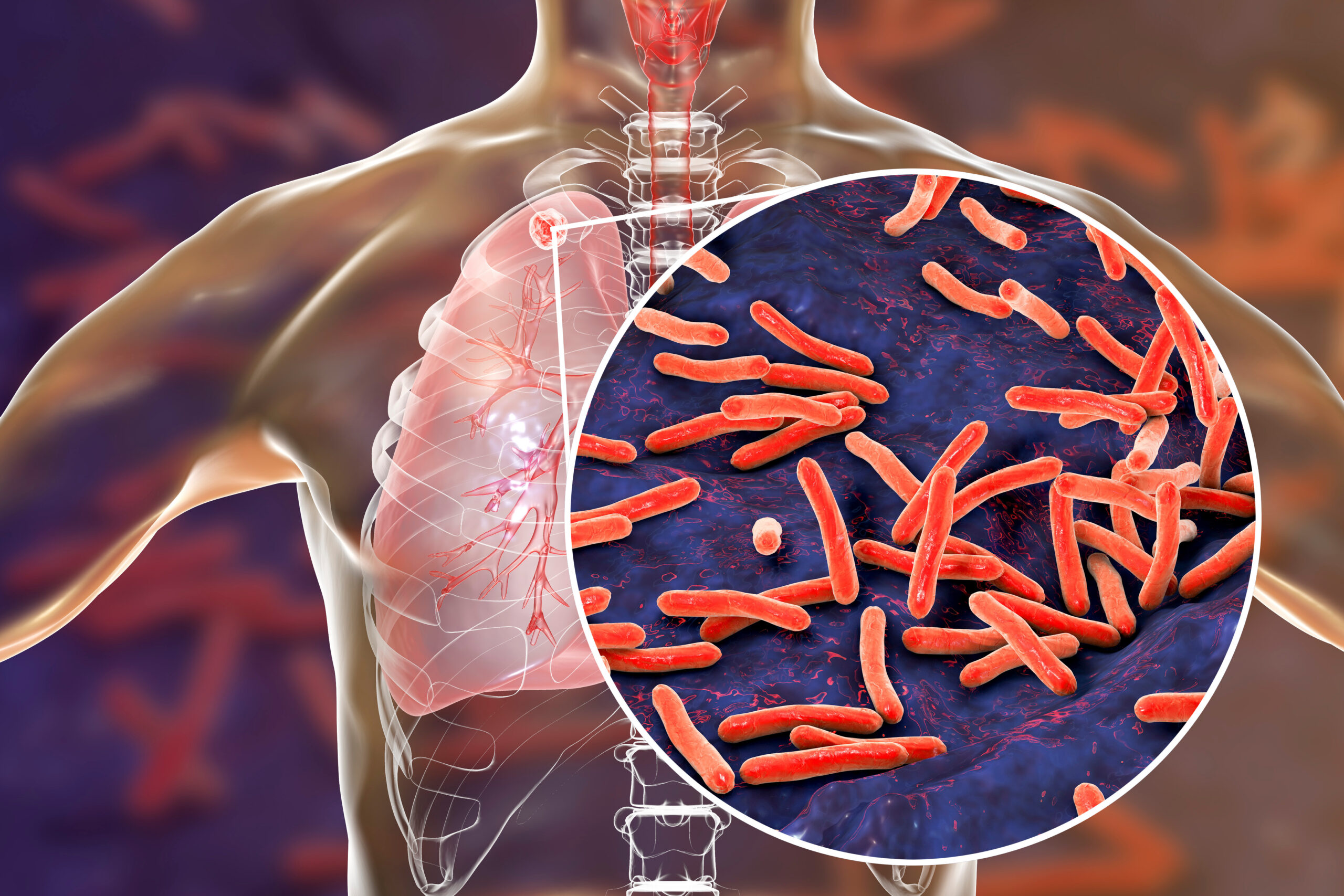 Secondary tuberculosis in lungs and close-up view of Mycobacterium tuberculosis bacteria