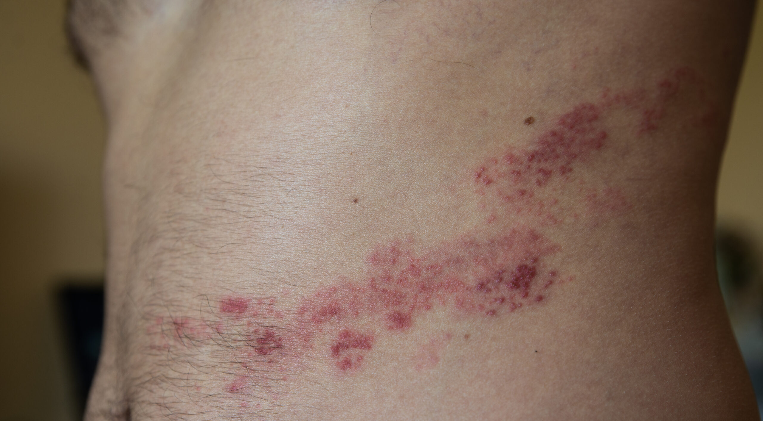 close up on herpes zoster on the stomach
