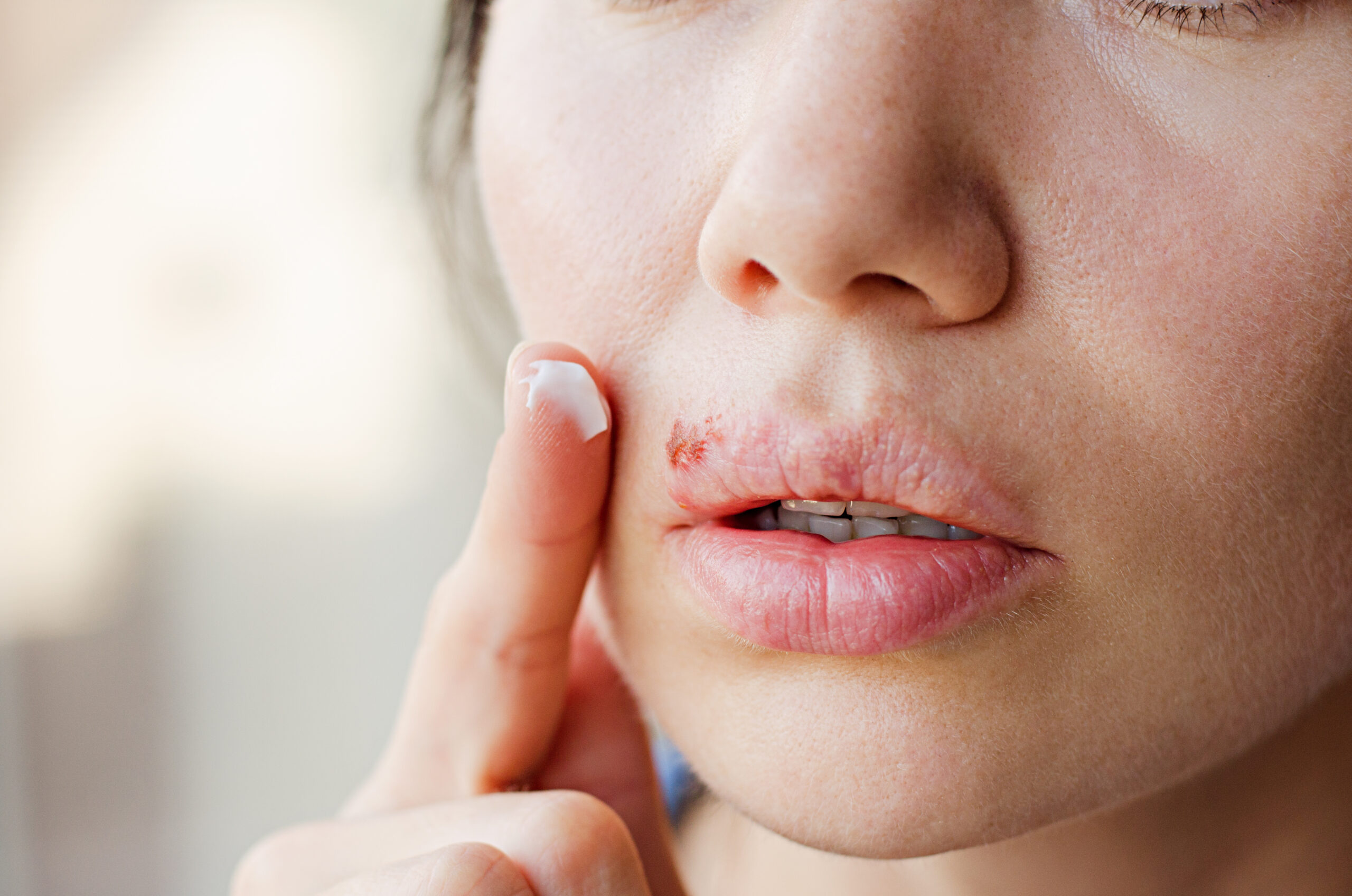 Part of a young woman’s face with a virus herpes on lips, treatment with ointment