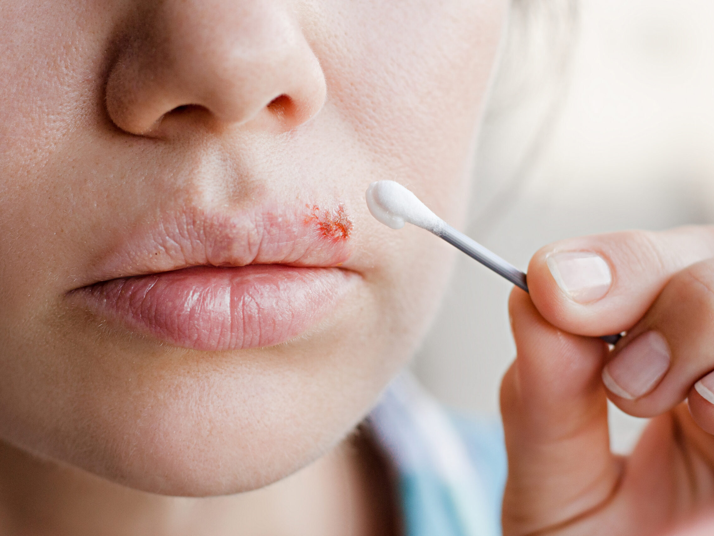 Lippenherpes: Versteckte Viren, gefährliche Küsse und Hoffnung auf neue Medikamente