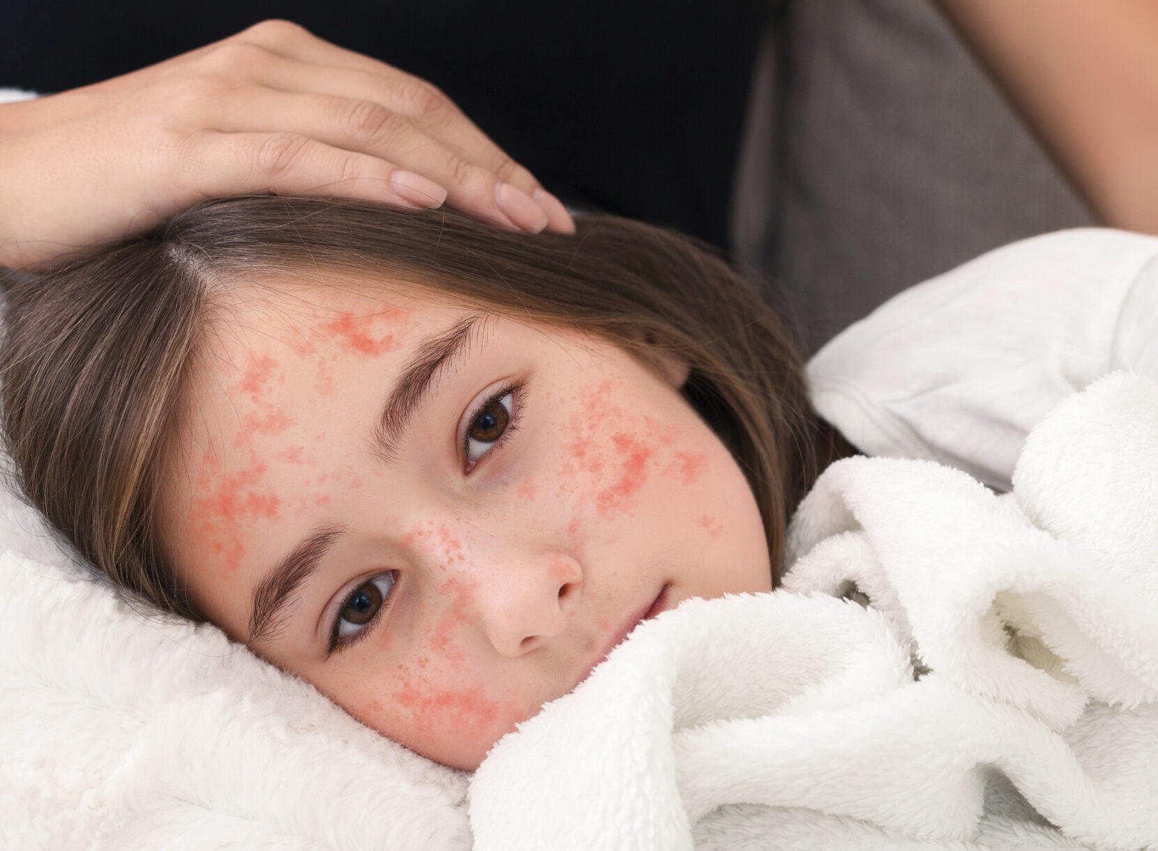 Girl With Measles Virus Lying On Mother Knees