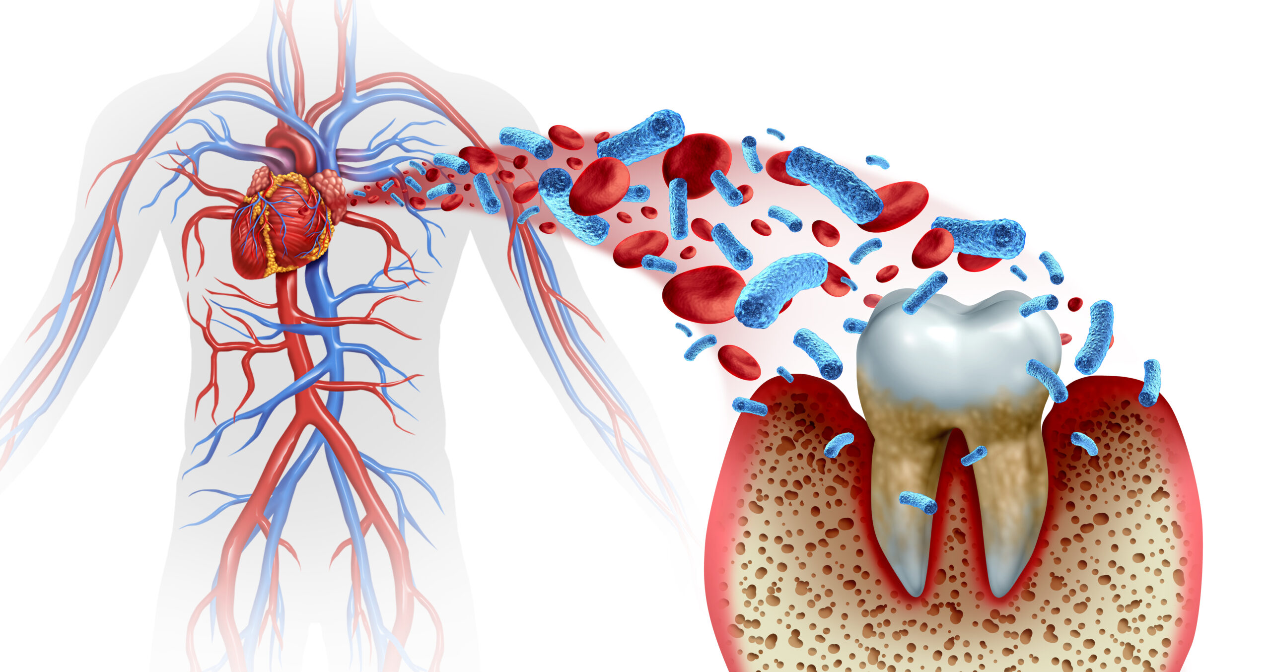 Tooth decay and heart disease as an unhealthy molar with periodontitis due to poor oral hygiene health problem as a bacteria infection in the blood as a concept with inflammation as a 3D illustration