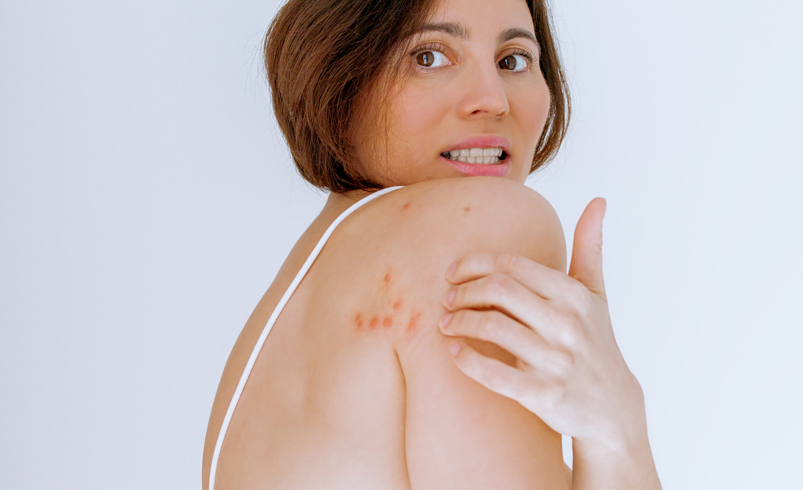 A woman scratches her shoulder bitten by a bedbug on a white background, close-up. Skin health problem. Red pimples.