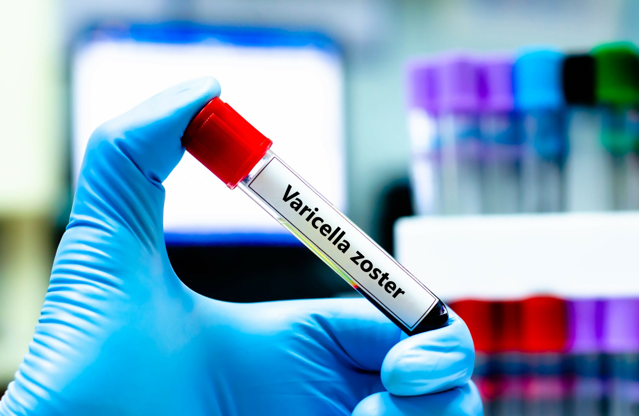 Blood sample tube for varicella zoster test analysis.